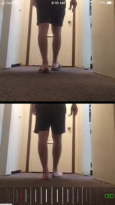 Flip flop causes foot shape to change